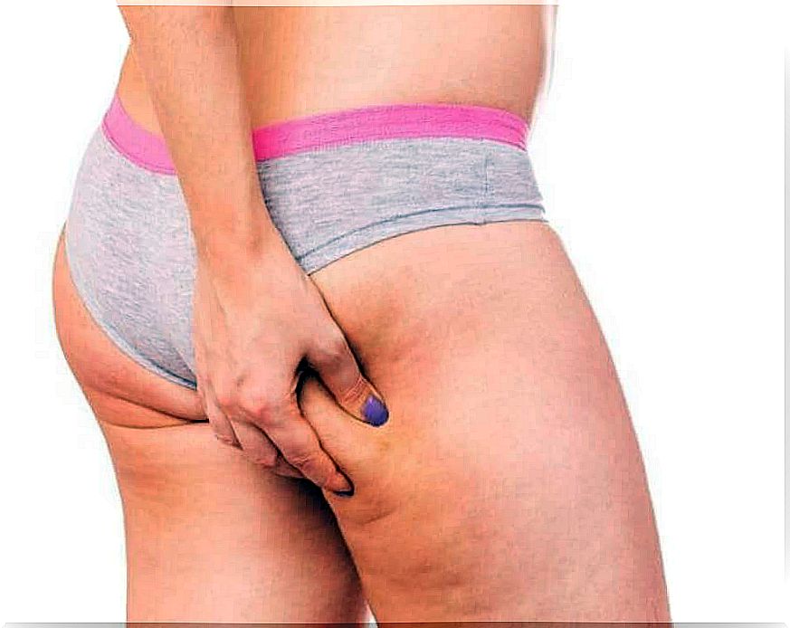 Cellulite in a woman's thigh