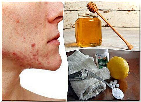 6 natural treatments for cystic acne