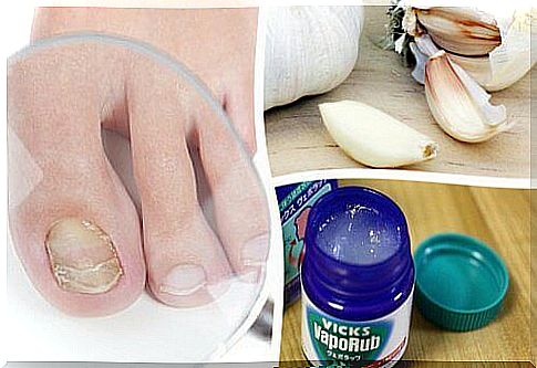 7 home remedies for nail fungus