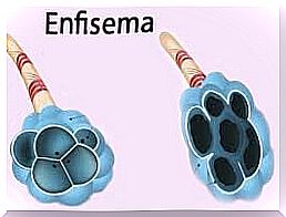 Chronic obstructive pulmonary disease