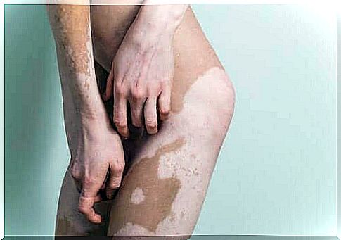 A person with vitiligo.