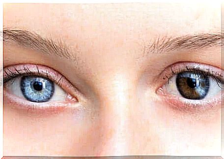 Woman with two different colors of eyes.