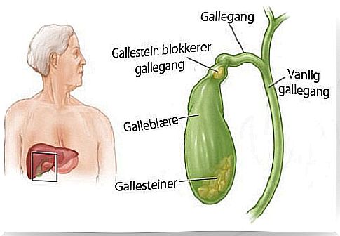 How do I know if I have gallstones?