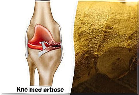 How to eliminate the symptoms of osteoarthritis