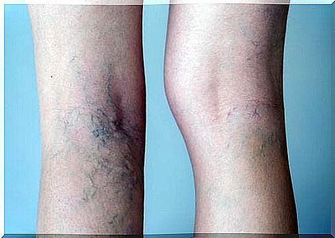 Prevent varicose veins