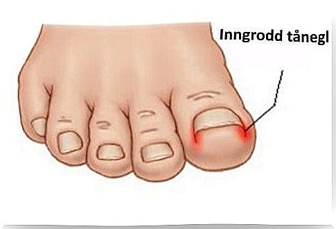 ingrown toenail