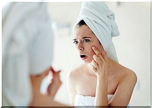 Woman with acne