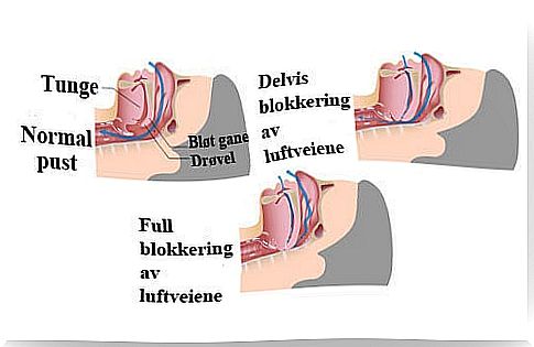 Blocked airways