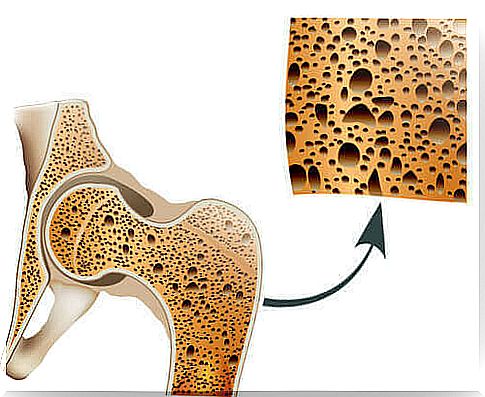 Risk of osteoporosis.