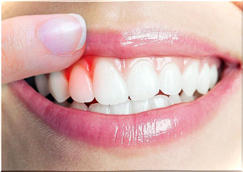 The 5 best remedies to relieve gingivitis