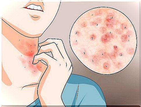 Three simple home remedies for scabies